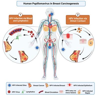 An updated systemic review and meta-analysis on human papillomavirus in breast carcinogenesis